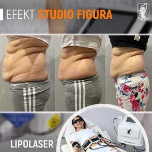 lipolaser