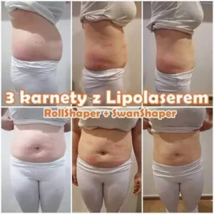 lipolaser