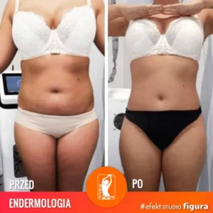endermologia