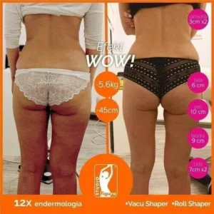 endermologia