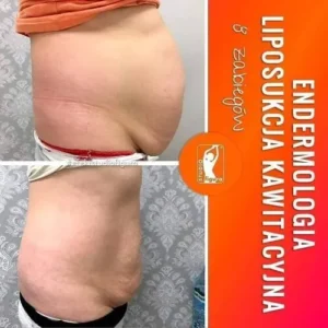 endermologia