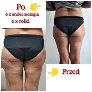 endermologia