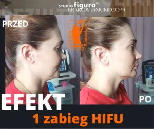 hifu