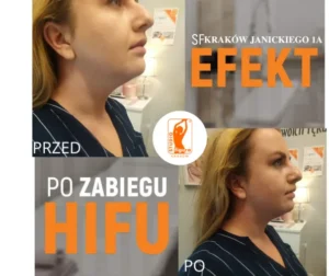 hifu