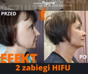 hifu