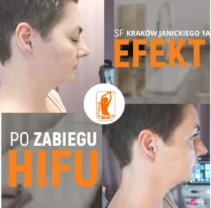hifu
