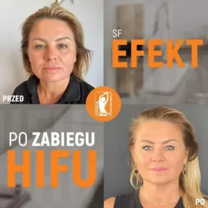 hifu