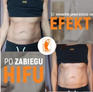 hifu