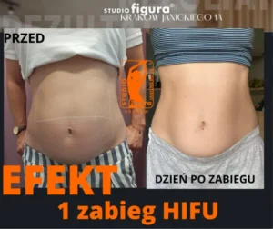 hifu