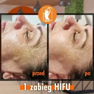 hifu