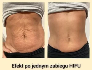 hifu