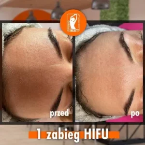 hifu