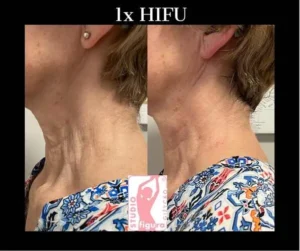 hifu