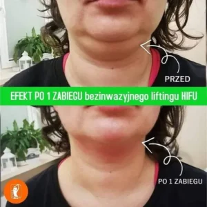 hifu