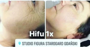 hifu