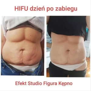 hifu