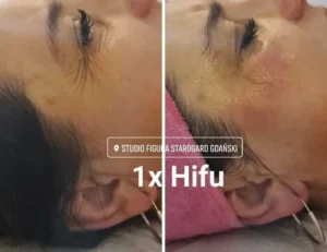 hifu