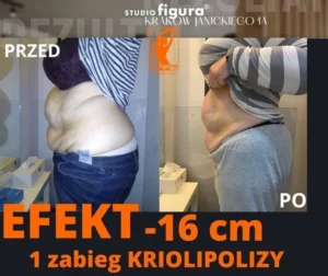 kriolipoliza