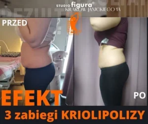 kriolipoliza