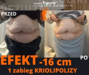kriolipoliza