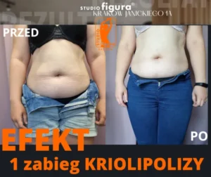 kriolipoliza