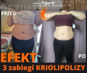 kriolipoliza