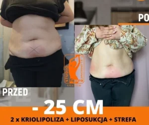 kriolipoliza