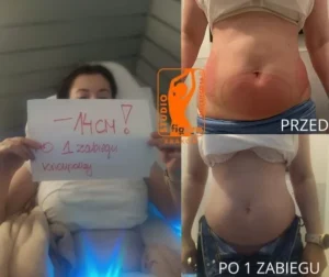 kriolipoliza