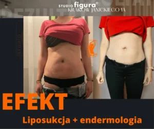 liposukcja