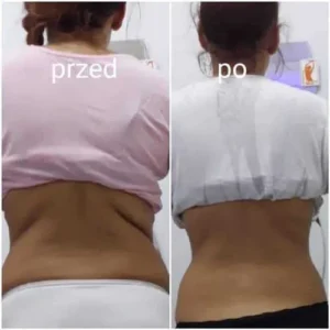 liposukcja